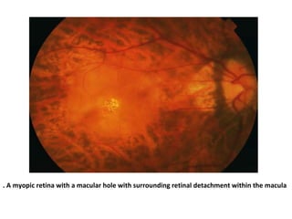 . A myopic retina with a macular hole with surrounding retinal detachment within the macula

 