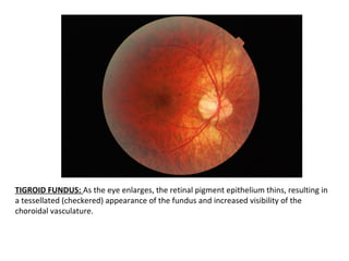 Myopia | PPT
