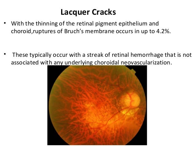 Lacquer Cracks Near The Macula Lacquer Cracks Near The Macula