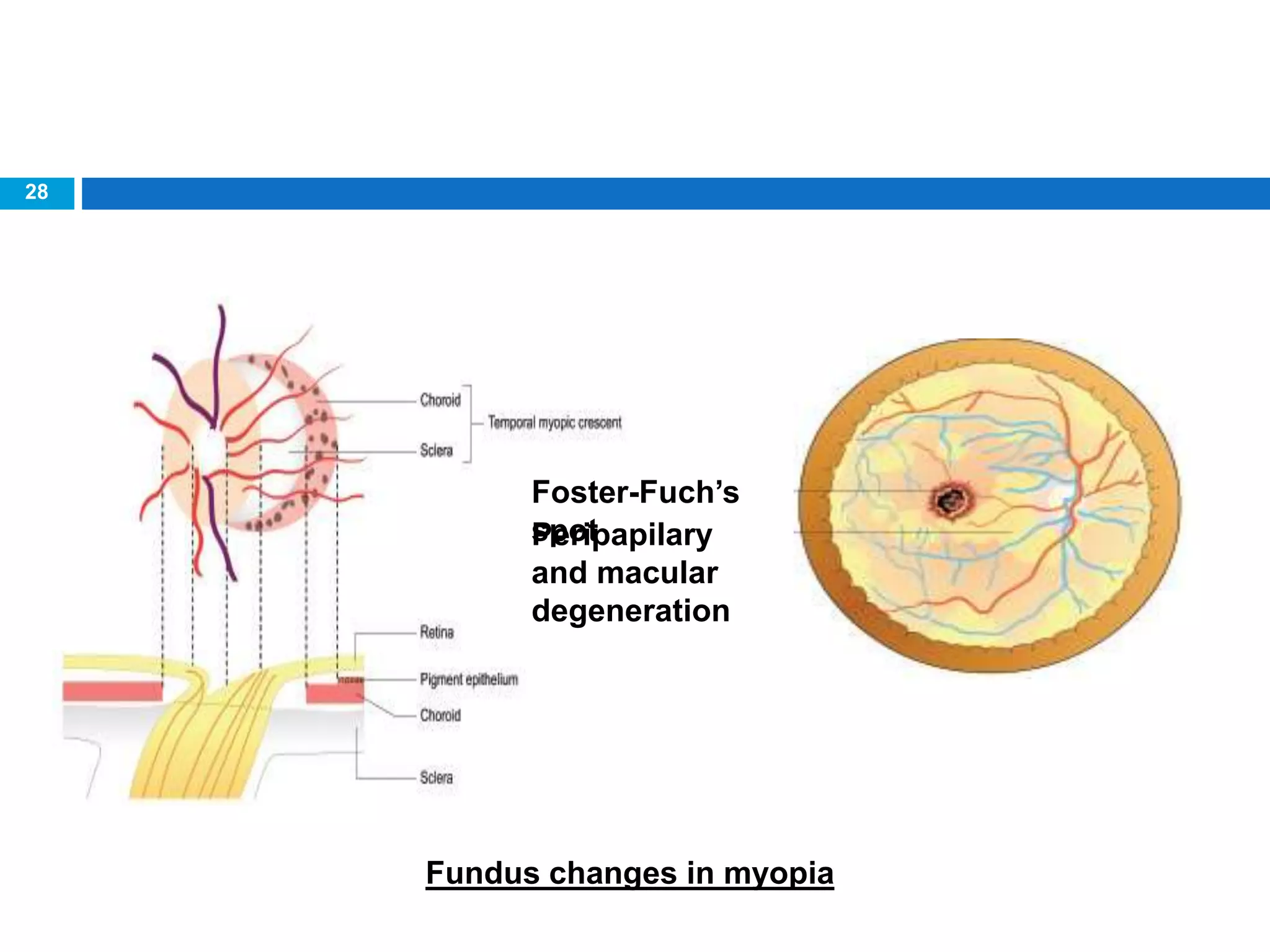 28
Fundus changes in myopia
Foster-Fuch’s
spotPeripapilary
and macular
degeneration
 