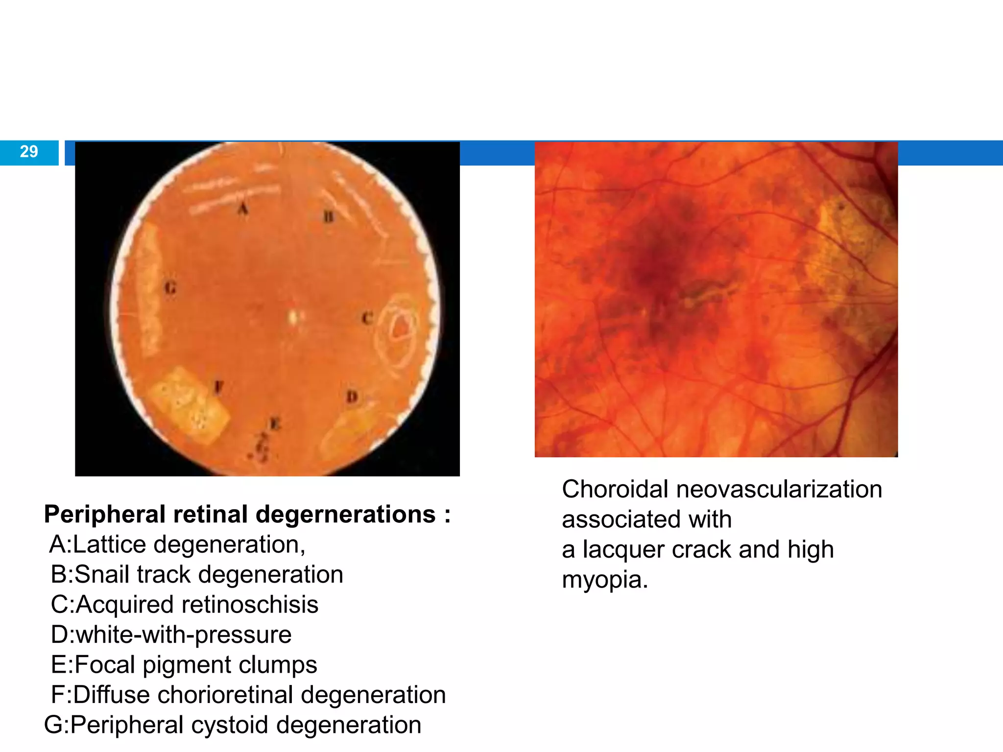 29
Choroidal neovascularization
associated with
a lacquer crack and high
myopia.
Peripheral retinal degernerations :
A:Lattice degeneration,
B:Snail track degeneration
C:Acquired retinoschisis
D:white-with-pressure
E:Focal pigment clumps
F:Diffuse chorioretinal degeneration
G:Peripheral cystoid degeneration
 
