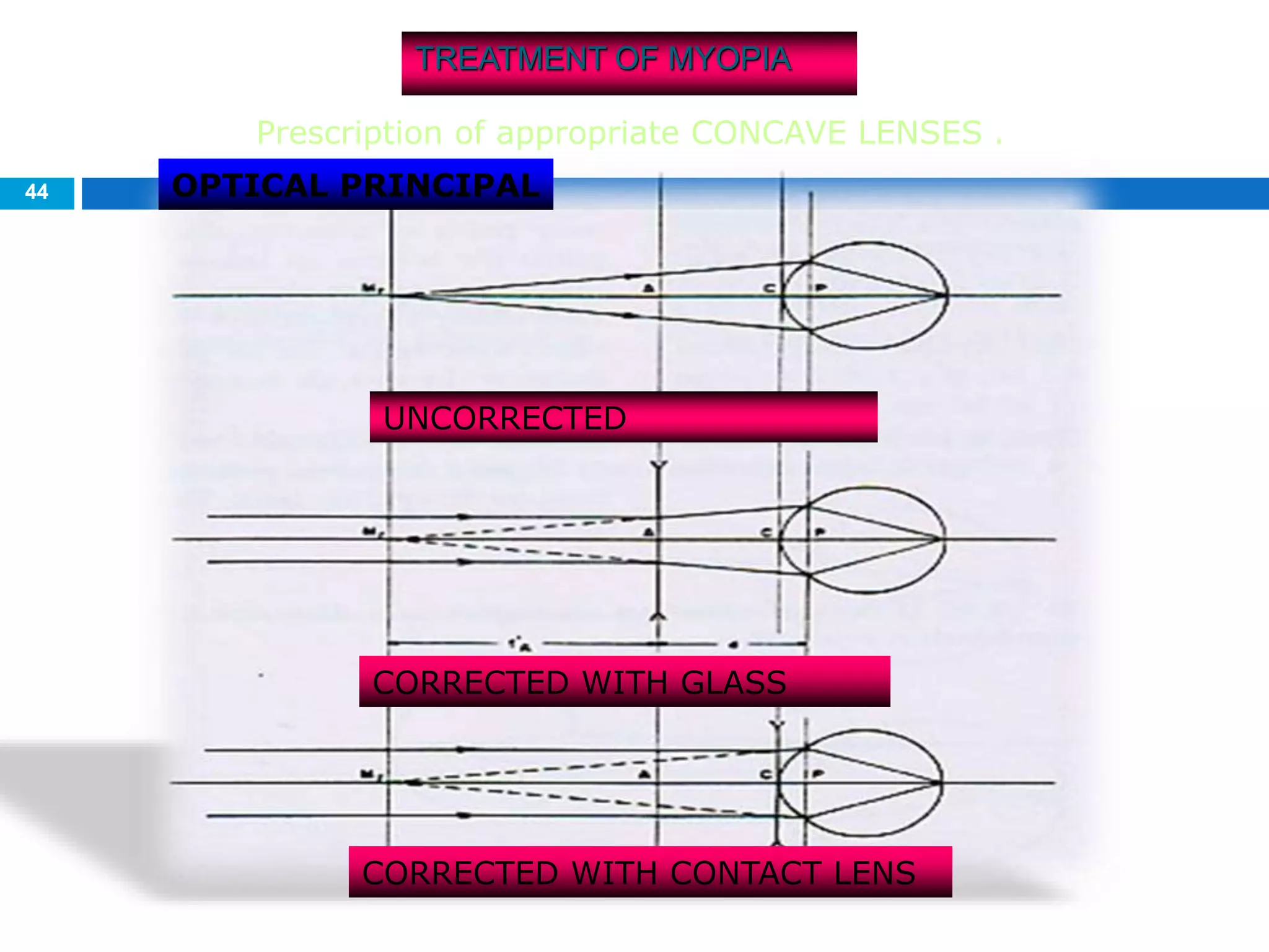 44
TREATMENT OF MYOPIA
OPTICAL PRINCIPAL
UNCORRECTED
CORRECTED WITH GLASS
CORRECTED WITH CONTACT LENS
Prescription of appropriate CONCAVE LENSES .
 