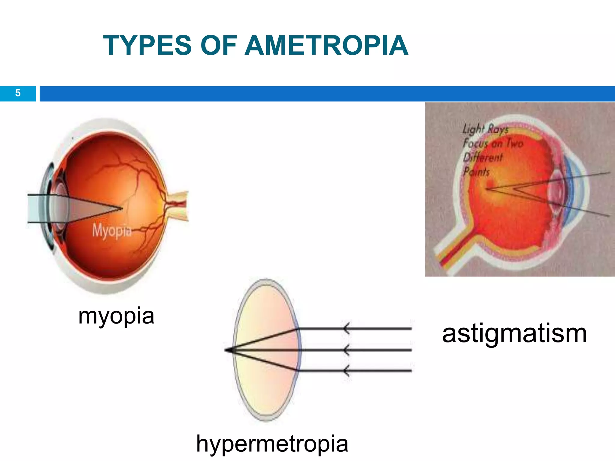 5
TYPES OF AMETROPIA
myopia
astigmatism
hypermetropia
 