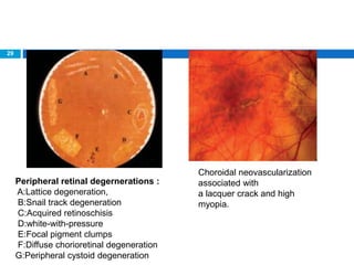 29
Choroidal neovascularization
associated with
a lacquer crack and high
myopia.
Peripheral retinal degernerations :
A:Lattice degeneration,
B:Snail track degeneration
C:Acquired retinoschisis
D:white-with-pressure
E:Focal pigment clumps
F:Diffuse chorioretinal degeneration
G:Peripheral cystoid degeneration
 
