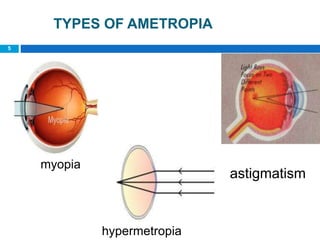 5
TYPES OF AMETROPIA
myopia
astigmatism
hypermetropia
 