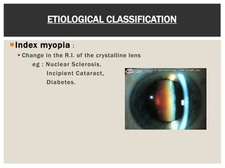 Index myopia :
 Change in the R.I. of the crystalline lens
eg : Nuclear Sclerosis,
Incipient Cataract,
Diabetes.
ETIOLOGICAL CLASSIFICATION
 
