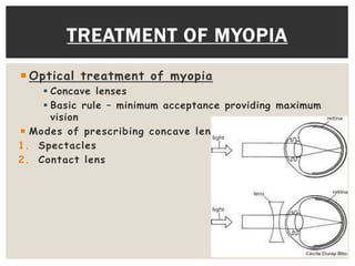TREATMENT OF MYOPIA 
Optical treatment of myopia 
 Concave lenses 
 Basic rule – minimum acceptance providing maximum 
vision 
 Modes of prescribing concave lens- 
1. Spectacles 
2. Contact lens 
 