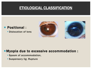ETIOLOGICAL CLASSIFICATION 
 Positional : 
 Dislocation of lens 
Myopia due to excessive accommodation : 
 Spasm of accommodation, 
 Suspensory lig. Rupture 
 
