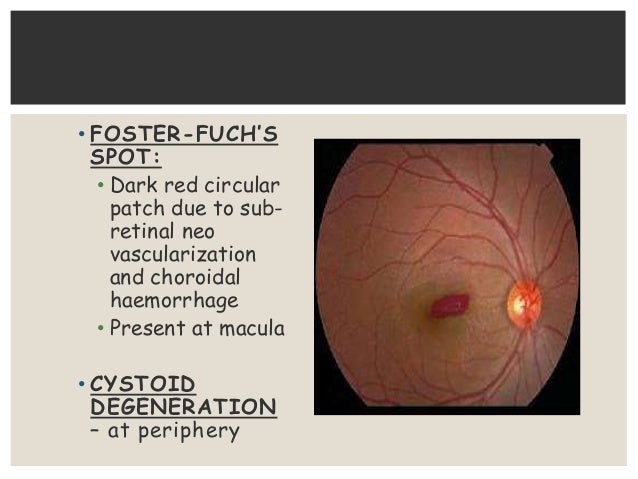  vitreous liquefaction vitreous opacities posterior vitreous detachment