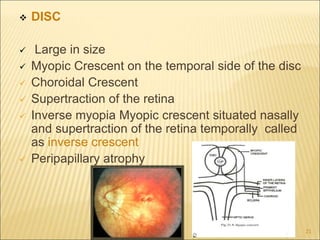  DISC
 Large in size
 Myopic Crescent on the temporal side of the disc
 Choroidal Crescent
 Supertraction of the retina
 Inverse myopia Myopic crescent situated nasally
and supertraction of the retina temporally called
as inverse crescent
 Peripapillary atrophy
21
 