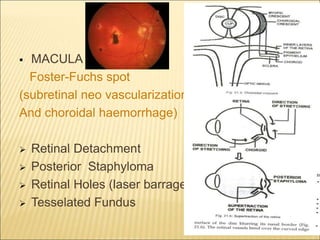  MACULA
Foster-Fuchs spot
(subretinal neo vascularization,
And choroidal haemorrhage)
 Retinal Detachment
 Posterior Staphyloma
 Retinal Holes (laser barrage)
 Tesselated Fundus
22
 