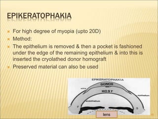 EPIKERATOPHAKIA
 For high degree of myopia (upto 20D)
 Method:
 The epithelium is removed & then a pocket is fashioned
under the edge of the remaining epithelium & into this is
inserted the cryolathed donor homograft
 Preserved material can also be used
35
lens
 