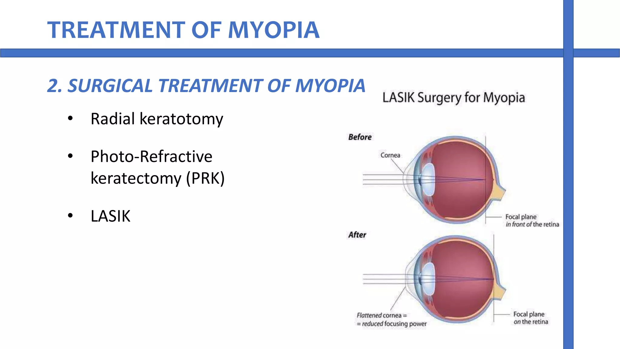Myopia refractive error of eye | PPT | Free Download