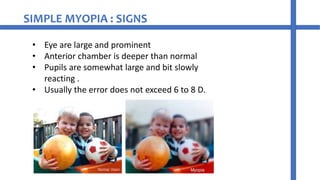 Myopia refractive error of eye | PPT