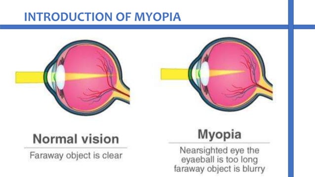 Myopia refractive error of eye | PPT