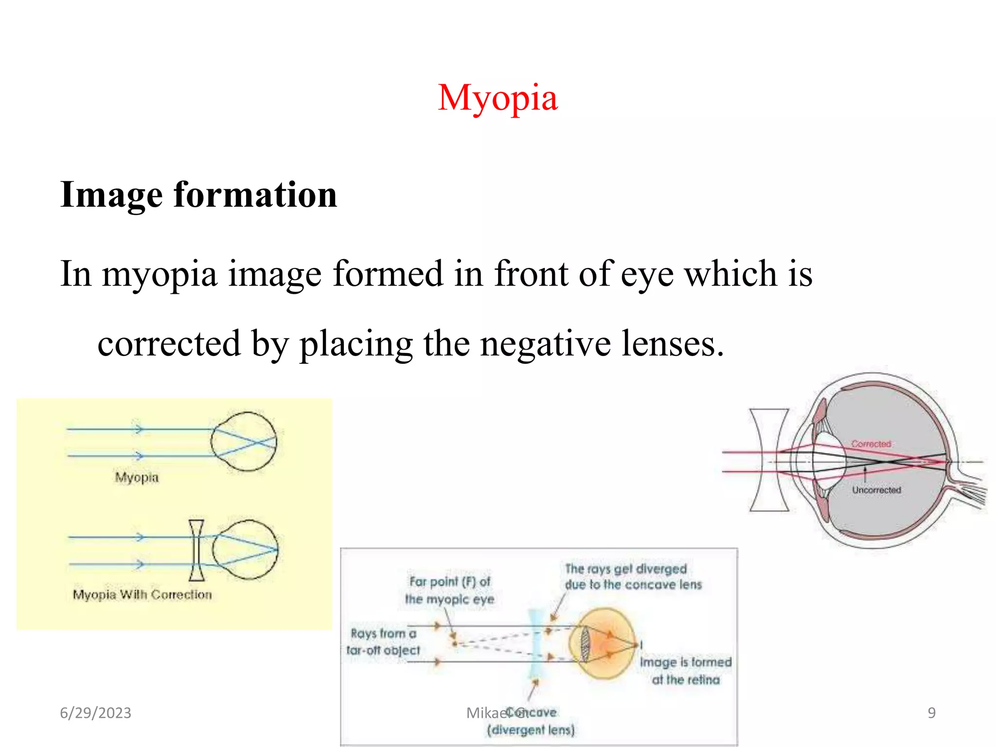 Myopia.pptx