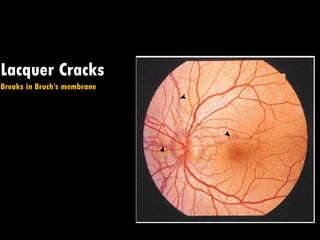 Lacquer Cracks
Breaks in Bruch’s membrane
 