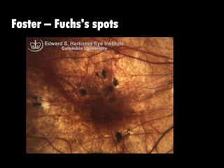 Foster – Fuchs's spots
 