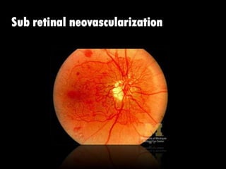 Sub retinal neovascularization
 