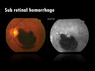 Sub retinal hemorrhage
 