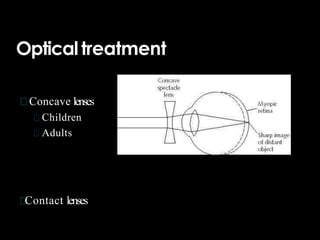Opticaltreatment
Concave lenses
Children
Adults
Contact lenses
 