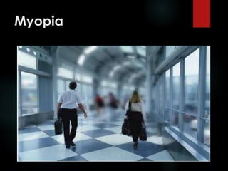 Myopia
 