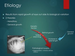 Etiology


Results from rapid growth of eye out side its biological variation



2 theories
- Hereditary

- General growth

Genetic
factors
Retinal growth
Scleral
stretching

Increase in
axial length

Pathological myopia
• Degeneration – choroid, retinae,
vitreous

 