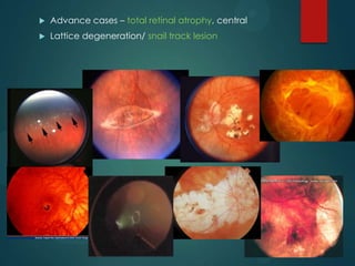 

Advance cases – total retinal atrophy, central



Lattice degeneration/ snail track lesion

 