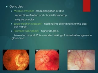 

Optic disc


Myopic crescent – from elongation of disc

separation of retina and choroid from temp
may be annular


Super traction crescent – nasal retina extending over the disc –
blur margin



Posterior staphyloma – higher degree,

herniation of post. Pole – sudden kinking of vessels at margin as in
glaucoma

 