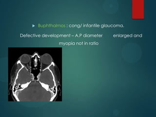 

Buphthalmos : cong/ infantile glaucoma.

Defective development – A.P diameter
myopia not in ratio

enlarged and

 