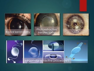 Radial keratotomy

Photorefractive
keratectomy

Intraocular refractive procedure's

LASIK

 