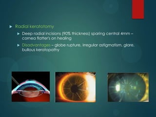 

Radial keratotomy


Deep radial incisions (90% thickness) sparing central 4mm –
cornea flatter's on healing



Disadvantages – globe rupture, irregular astigmatism, glare,
bullous keratopathy

 
