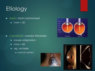 Etiology


Axial : most commonest




1mm = 3D

Curvatural : cornea thickness


causes astigmatism



1mm = 6D



eg : ectasies


conical cornea

 