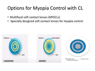 Options for Myopia Control with CL
• Multifocal soft contact lenses (MFSCLs)
• Specially designed soft contact lenses for myopia control
•
•
 
