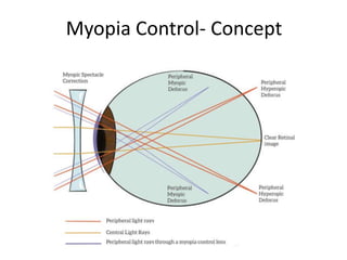Myopia Control- Concept
 