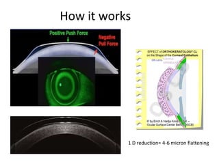 How it works
1 D reduction= 4-6 micron flattening
 