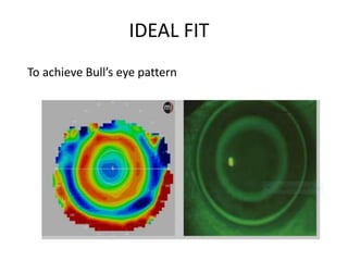 IDEAL FIT
To achieve Bull’s eye pattern
 