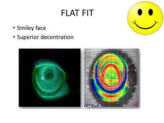 FLAT FIT
• Smiley face
• Superior decentration
 