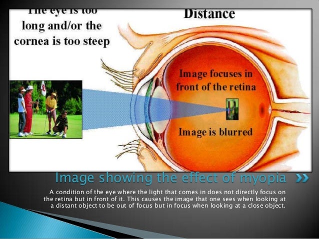 What is myopic eye disease?