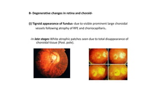 myopia & hypermetropia.pptx