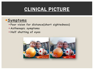 Myopia | PPTX