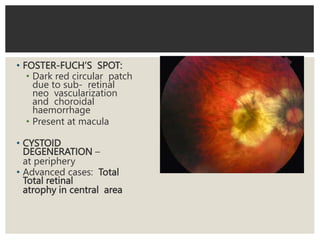 • FOSTER-FUCH’S SPOT:
• Dark red circular patch
due to sub- retinal
neo vascularization
and choroidal
haemorrhage
• Present at macula
• CYSTOID
DEGENERATION –
at periphery
• Advanced cases: Total
Total retinal
atrophy in central area
 