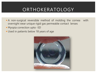 ◾A non-surgical reversible method of molding the cornea with
overnight wear unique rigid gas permeable contact lenses
◾Myopia correction upto -5D
◾Used in patients below 18 years of age
ORTHOKERATOLOGY
 