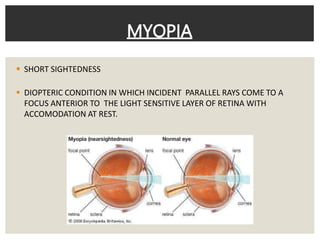  SHORT SIGHTEDNESS
 DIOPTERIC CONDITION IN WHICH INCIDENT PARALLEL RAYS COME TO A
FOCUS ANTERIOR TO THE LIGHT SENSITIVE LAYER OF RETINA WITH
ACCOMODATION AT REST.
MYOPIA
 