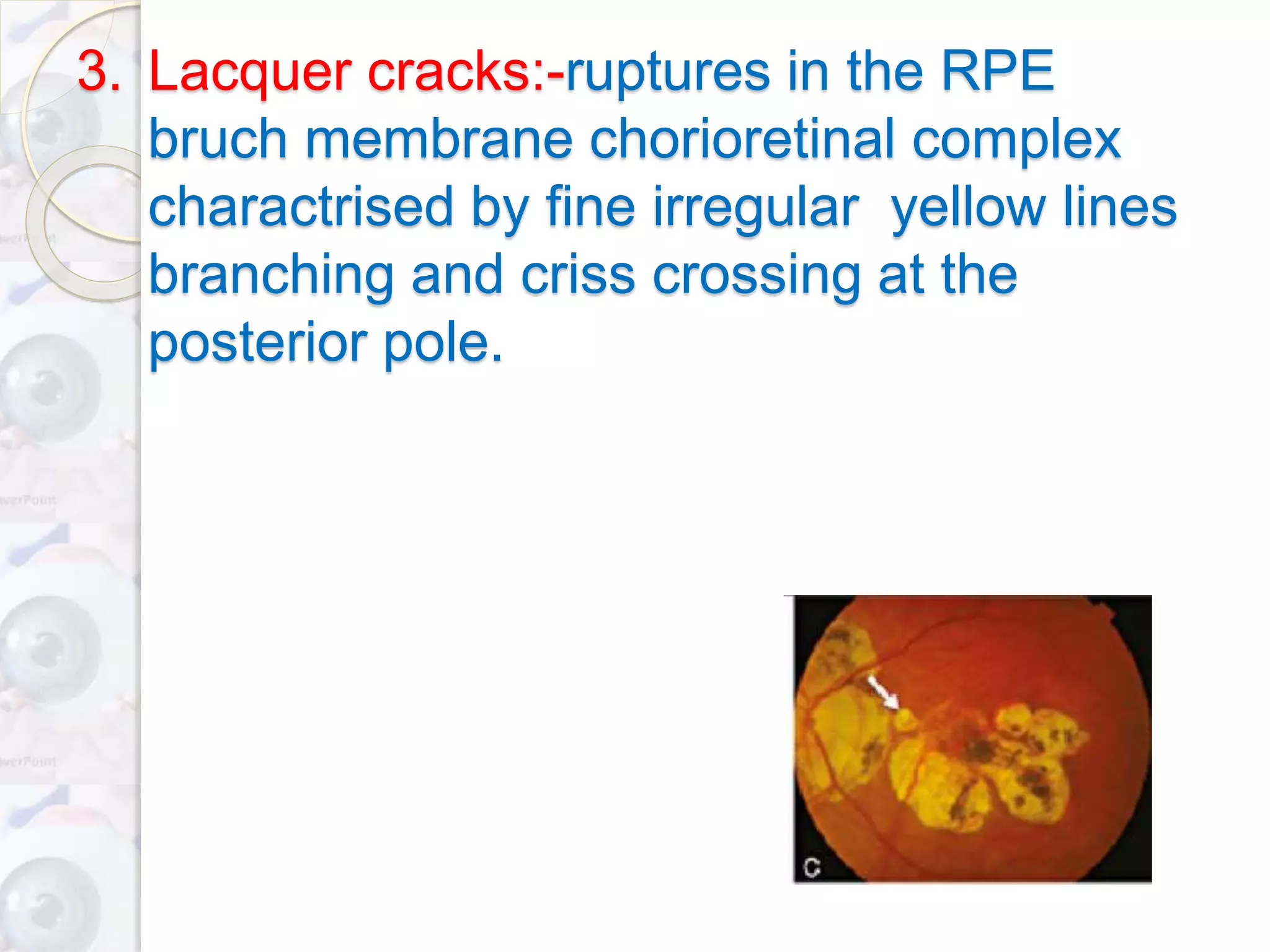 3. Lacquer cracks:-ruptures in the RPE
bruch membrane chorioretinal complex
charactrised by fine irregular yellow lines
branching and criss crossing at the
posterior pole.
 