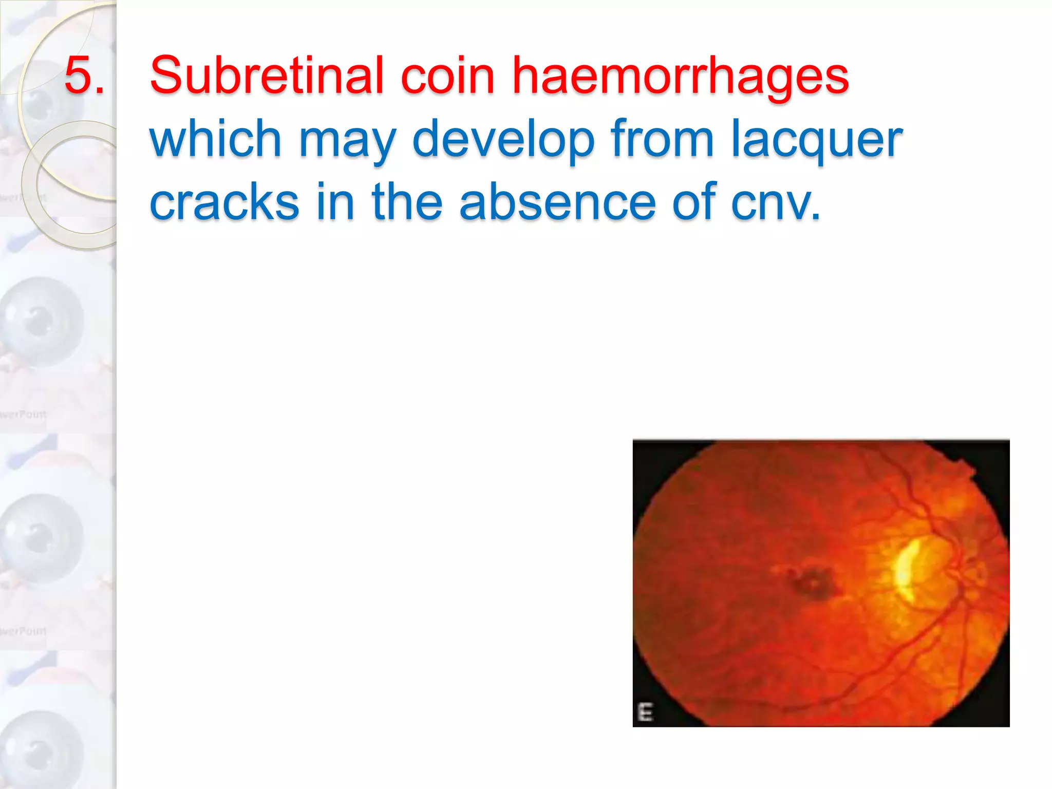 5. Subretinal coin haemorrhages
which may develop from lacquer
cracks in the absence of cnv.
 