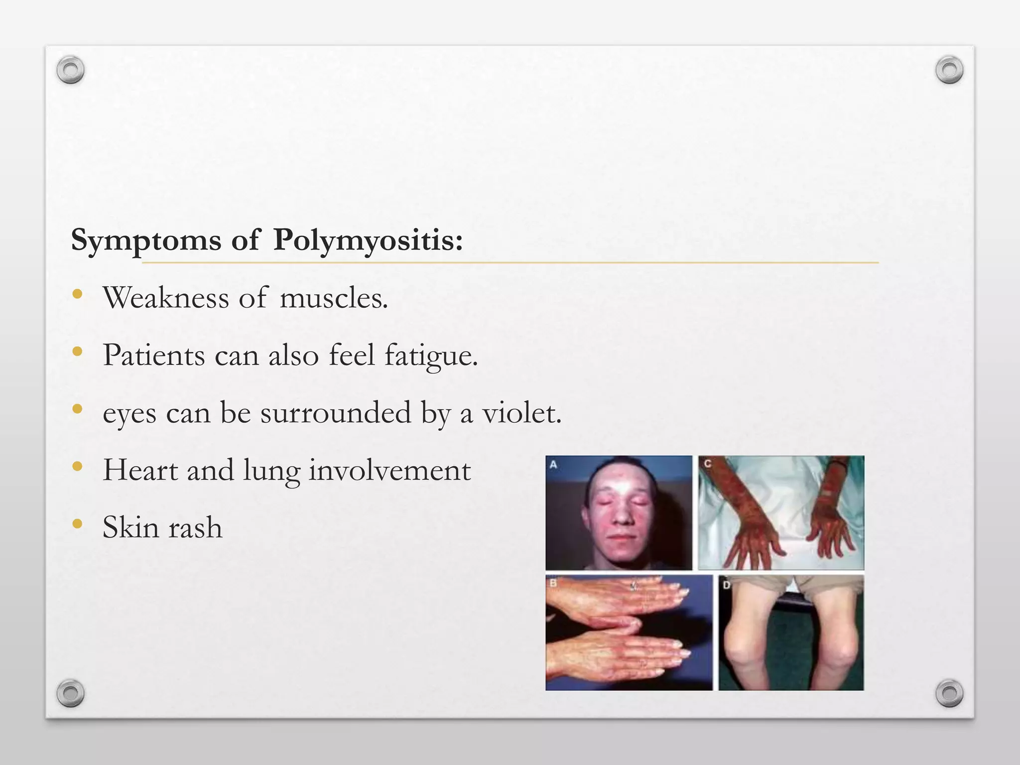Symptoms of Polymyositis:
• Weakness of muscles.
• Patients can also feel fatigue.
• eyes can be surrounded by a violet.
• Heart and lung involvement
• Skin rash
 