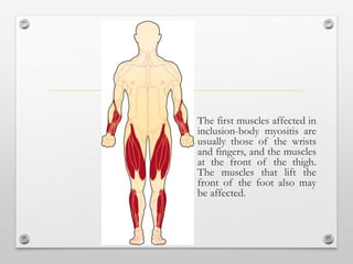 The first muscles affected in
inclusion-body myositis are
usually those of the wrists
and fingers, and the muscles
at the front of the thigh.
The muscles that lift the
front of the foot also may
be affected.
 