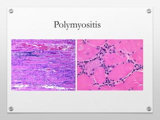 Polymyositis
 