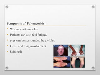 Symptoms of Polymyositis:
• Weakness of muscles.
• Patients can also feel fatigue.
• eyes can be surrounded by a violet.
• Heart and lung involvement
• Skin rash
 